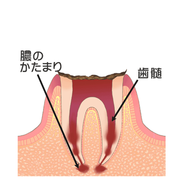 歯の根まで達した虫歯