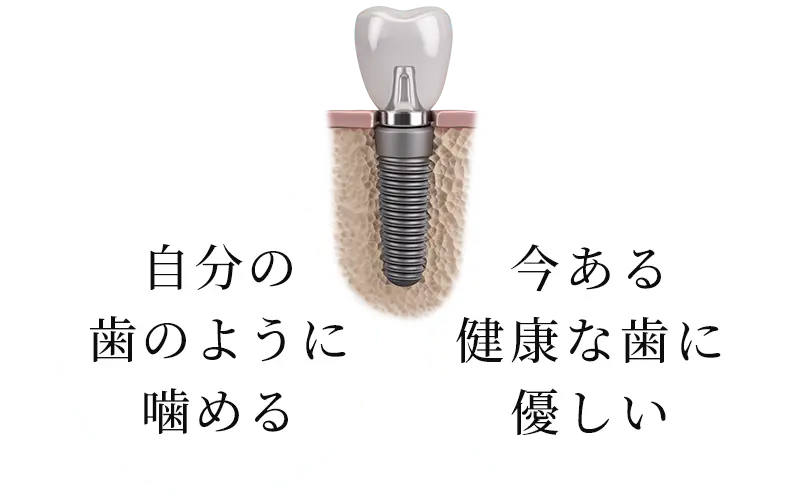 インプラント