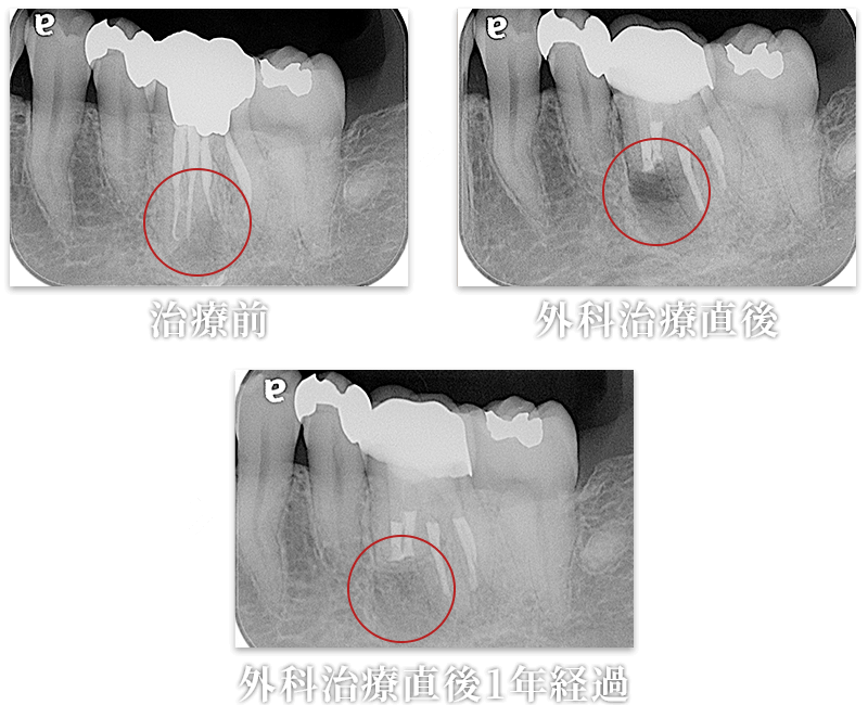 外科的歯内療法（臼歯）