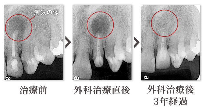 顎関節症の原因と治療法