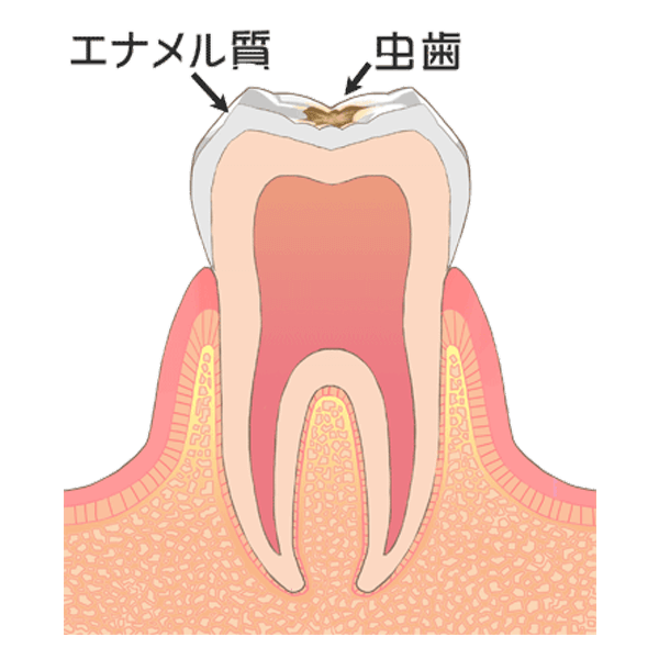 歯の表層（エナメル質）の虫歯