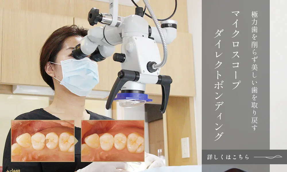 ダイレクトボンディング