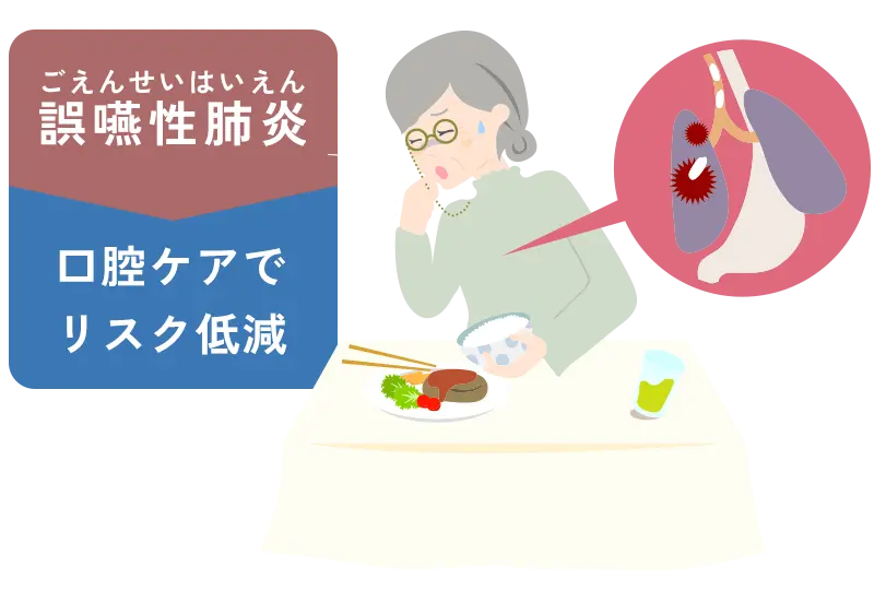 誤嚥性肺炎のリスク